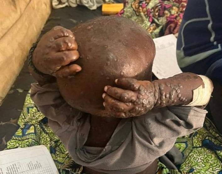 La Variole du singe continue de causer des ravages en République démocratique du Congo, des mesures&nbsp;s’imposent.